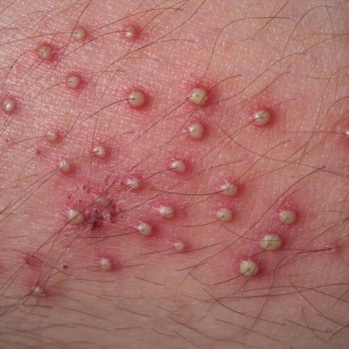 Những Thực Phẩm Nên Bổ Sung Để Hỗ Trợ Chữa Viêm Nang Lông tại Đà Nẵng