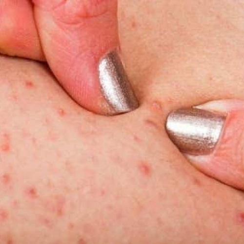 Chăm sóc sau khi điều trị viêm nang lông tại Đà Nẵng