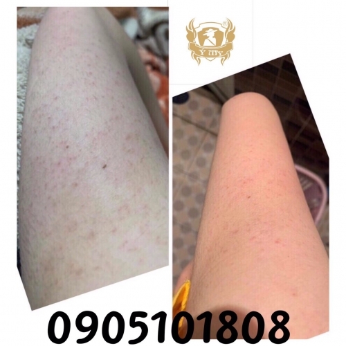 Các phương pháp điều trị viêm nang lông tại Đà Nẵng phổ biến