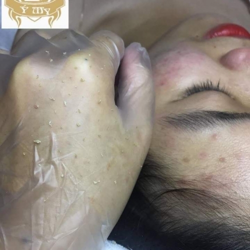 Mách bạn kinh nghiệm chọn Dịch vụ điều trị mụn tái tạo da sinh học tại Đà Nẵng