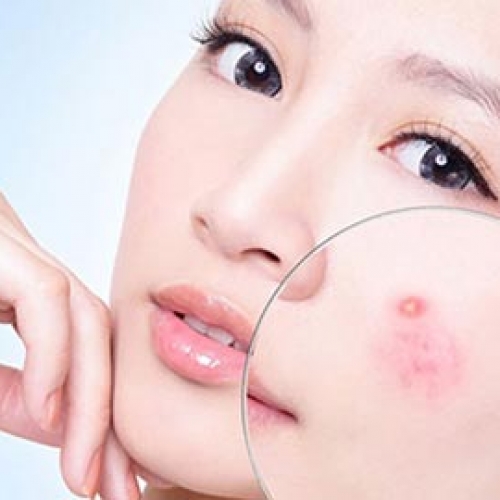 Các phương pháp điều trị mụn tại Đà Nẵng phổ biến