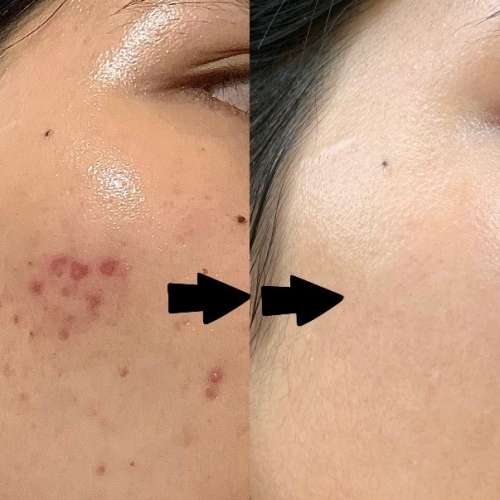 5 cách điều trị mụn trứng cá tại Đà Nẵng từ nhẹ đến nặng chi tiết cực an toàn