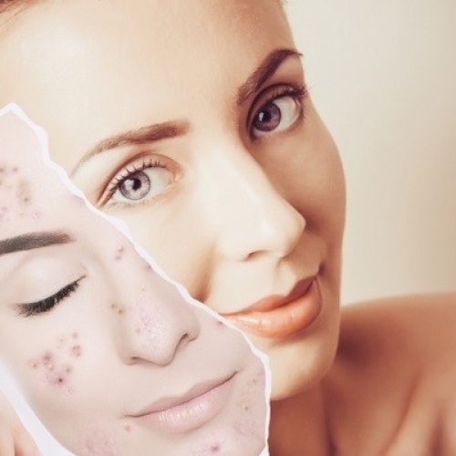 Làm thế nào để lựa chọn đơn vị điều trị mụn tại Đà Nẵng uy tín