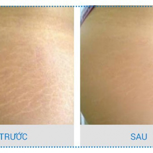 Đừng vội chọn dịch vụ điều trị rạn da tại Đà Nẵng nếu bạn chưa đọc bài viết này!