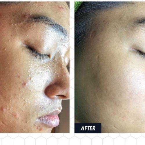 Lợi ích của dịch vụ điều trị mụn tại Đà Nẵng