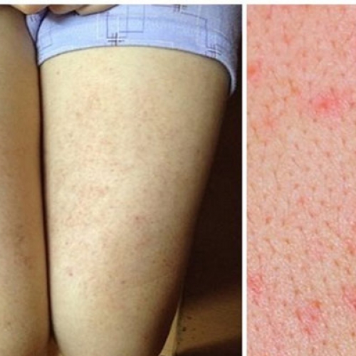 Điều trị viêm nang lông tại Đà Nẵng thế nào?