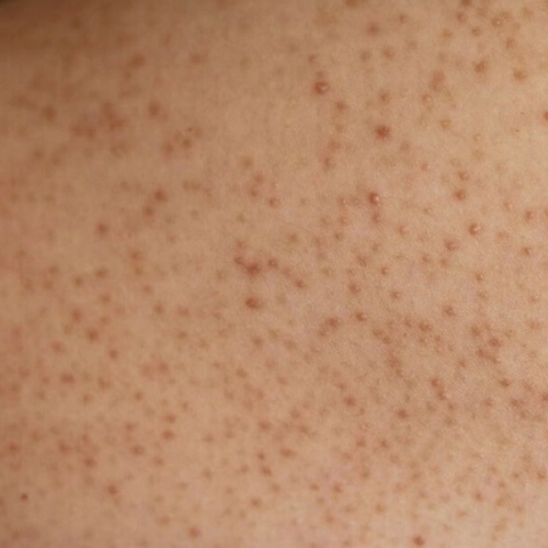  ĐIỀU TRỊ VIÊM NANG LÔNG TẠI ĐÀ NẴNG: HƯỚNG DẪN ĐẦY ĐỦ & HIỆU QUẢ