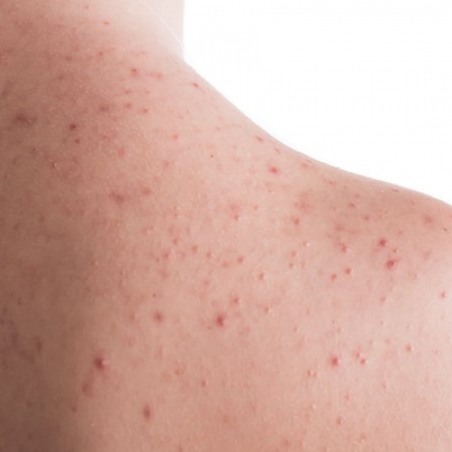 12 cách điều trị viêm nang lông tại Đà Nẵng hiệu quả, dứt điểm chuẩn y khoa